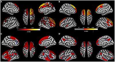 Substance-Specific and Shared Gray Matter Signatures in Alcohol, Opioid, and Polysubstance Use Disorder